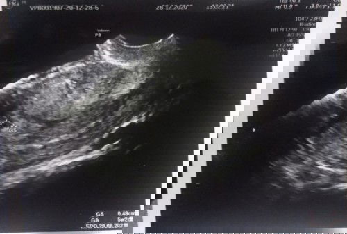 Ibu2 mau tny, hamil 5w tp baru terlihat kantung kehamilan dgn uk sekian normal/tidak? Terimakasih bu