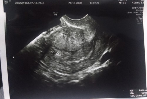 Ibu2 mau tny, hamil 5w tp baru terlihat kantung kehamilan dgn uk sekian normal/tidak? Terimakasih bu