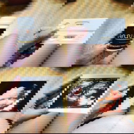 PCOS Baby 👶❤️