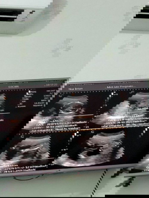 alhamdulillah 2x usg baby boy