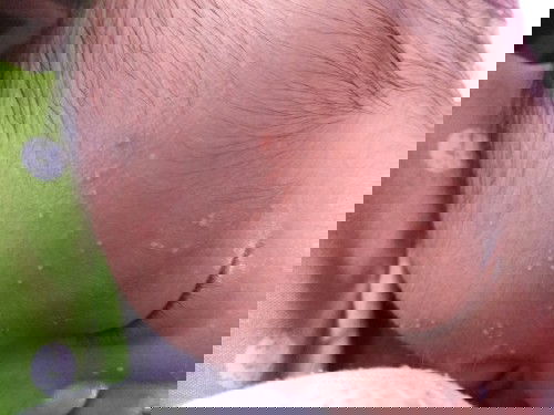 Cara hilangkan Jerawat pada bayi