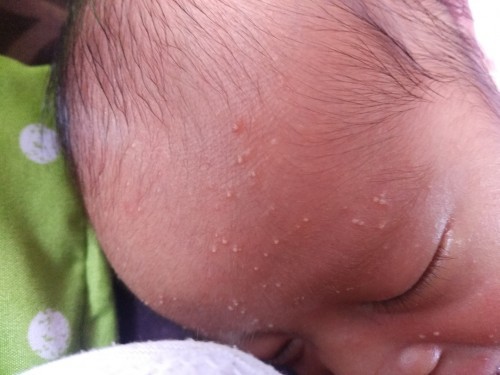 Cara hilangkan Jerawat pada bayi