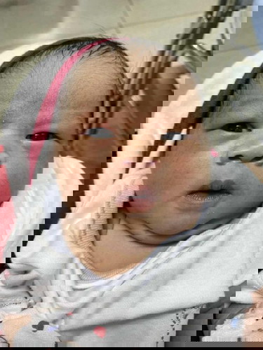 เป็นสิวข้าวสาร