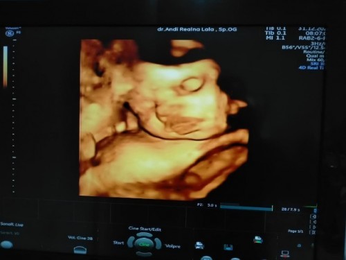 Hasil USG UK 33week