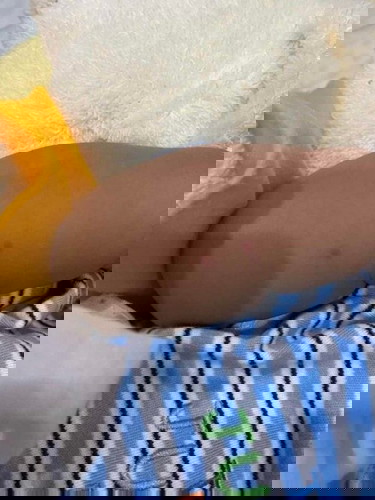 น้องจุดแดงๆแบบนี่ขึ้นมา4-5จุดเพราะอะไรคะ ใช่พวกมดยุงหรืออะไรหรือป่าว?