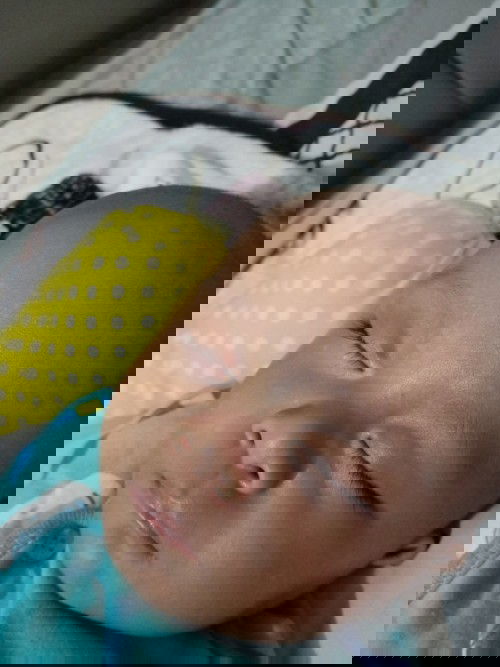 bercak putih dan bruntusan pada bayi