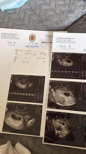 คุณแม่ท้องแฝดฝากครรภ์ที่ไหนกันคะ ที่กรุงเทพ ช่วยแนะนำทีค่ะ ขอบคุณค่ะ