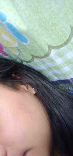 Ruam merah di wajah saat hamil