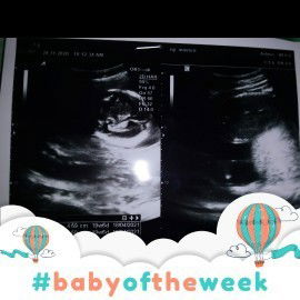 Usia khmln 6bln. Tp posisi plasenta msh di bawah . Apakah msh bsa berubah posisi plasenta bayi saya