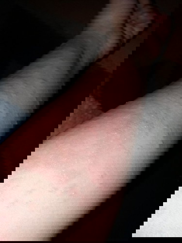 Skin rashes after giving birth