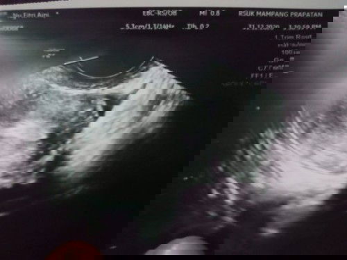 Arti USG yg membingungkan