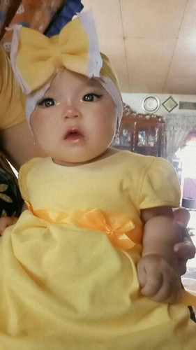 Bayi gumoh