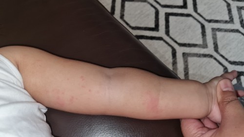 My girl has hives ever since she took her 2nd dose chicken pox jab. Anyone with the same problem?