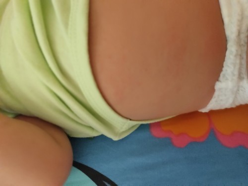 Iritasi minyak telon