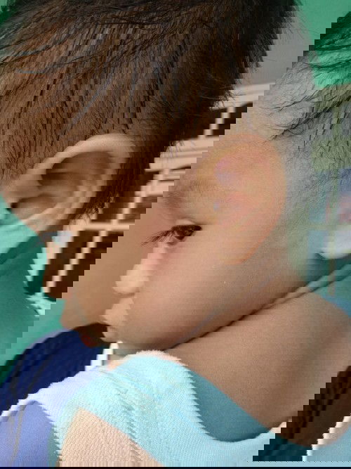 bercak melingkar putih diwajah