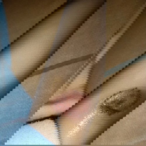 Ruam atau eksim pada kulit baby? Mohon bantuannya