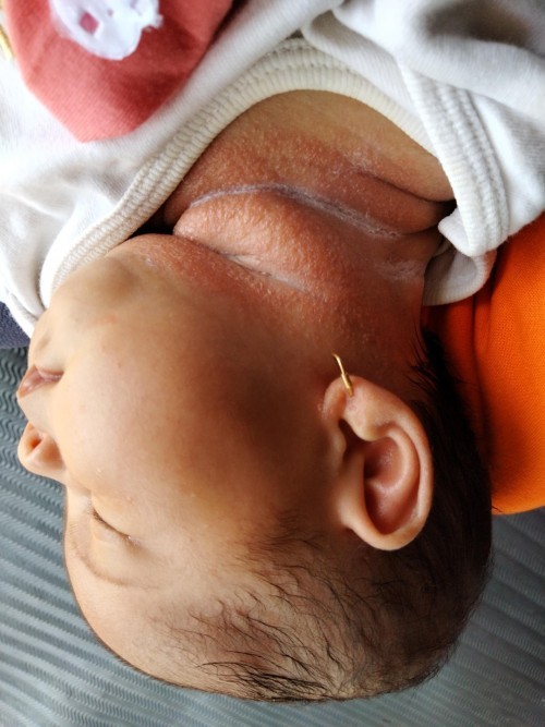 Leher bayi kemerahan