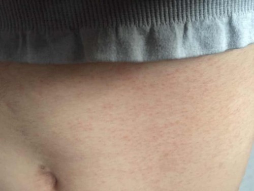 ผดผื่นตอนตั้งครรภ์ ไตรมาสแรก