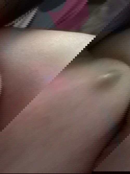 Vết tiêm bị sưng