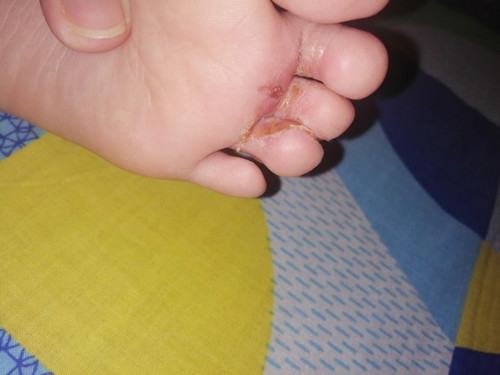 Scabies nga ba?