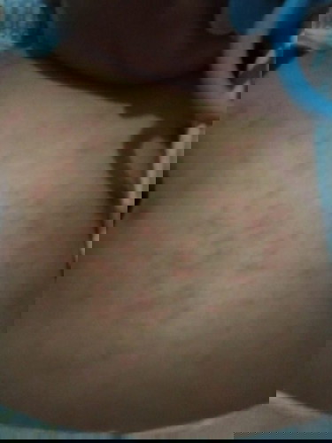 rashes