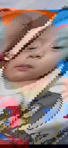 Chicken pox