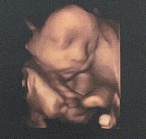 ท้อง 7 เดือน สายสะดือพันคอ 😥