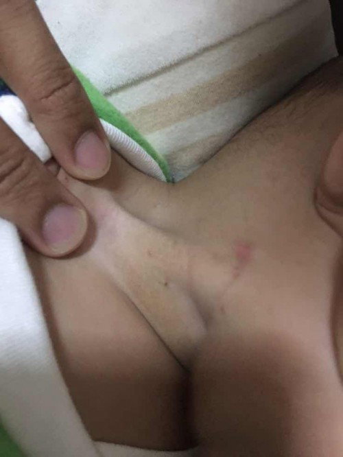 ลูกน้อยมีตุ่มคล้ายๆแบบนี้ เกิดจากอะไรคะ