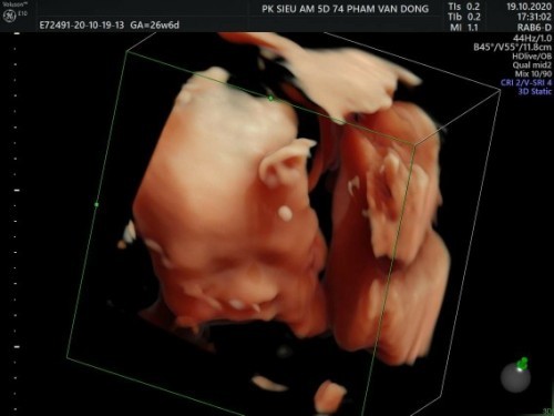 Các mom cho em hỏi.em mang thai tuần 38.2ngay nay em hay bị chảy máu mũi, ít,thì cho em hỏi sao ạ ca