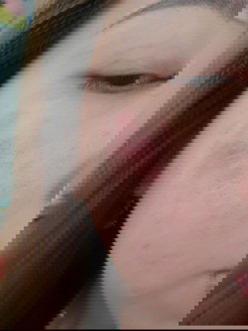 Nấm da và bị nổi chàm