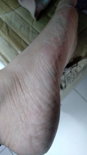 Bu ibu, ada yg semenjak hamil kulit jd kering bgt ga ? Sampe bibir pun pecah" ada solusi kah ?