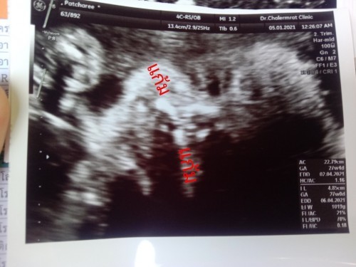 อายุครรภ์27w+1