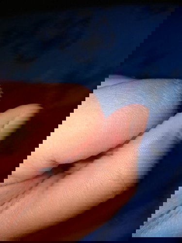 Dog bite by accident