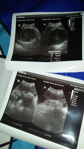 Hamil 35 minggu lebih tp plasenta udah pengapuran. Hamil pertama, gimana yah bunda aku takut kenapa2