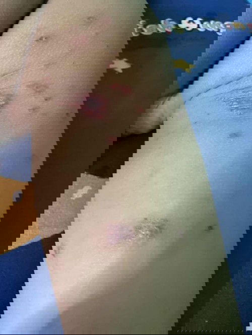 เป็นแผลถลอกที่ก้น