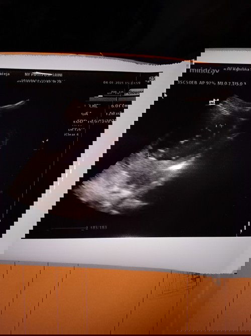 Hamil 12minggu 6hari USG & hasilnya bayi masih ukuran 6cm itu ukuran bayinya normal atau tidak Mam??