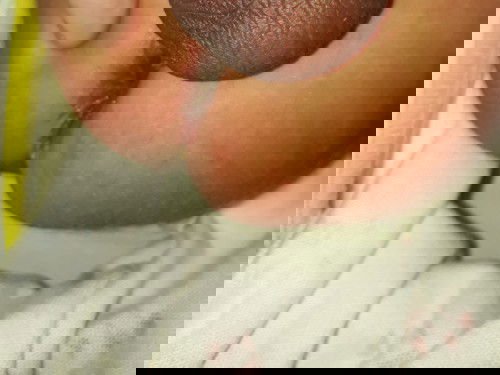 Bagian dubur bayi mengelupas