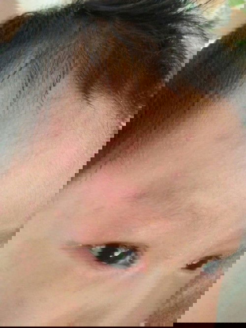 ลูกเป็นผื่น