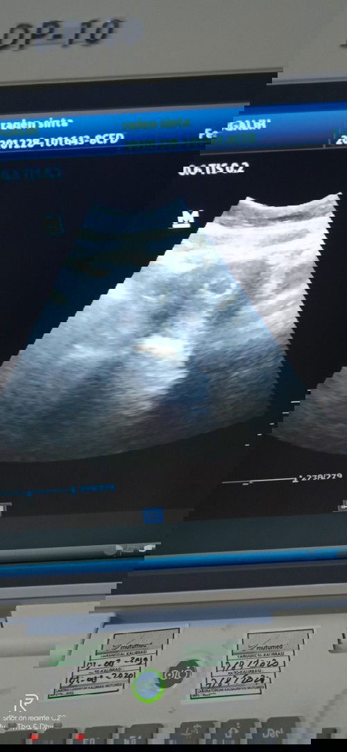 Hamil 8 Minggu masih berupa kantung