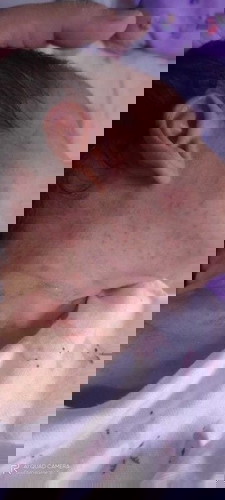 Rashes?? What to do?