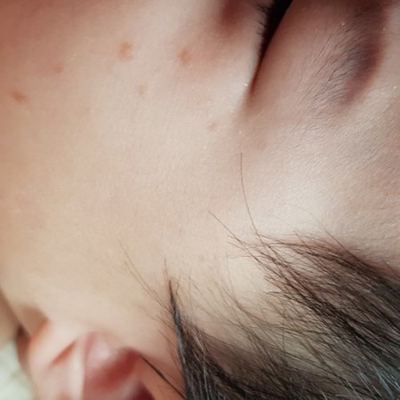 Baby has red bumps on cheek