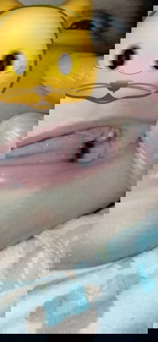 Bun,bayi aku umur 3 bulan 20 hari udh tumbuh gigi graham atas...ini normal apa gimanq yah