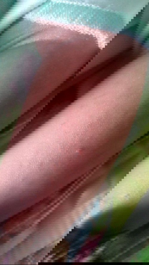 Obat untuk beruntusan