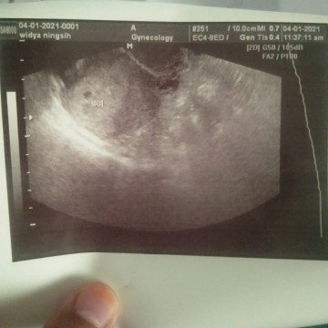 Hasil USG Usia 7 Week
