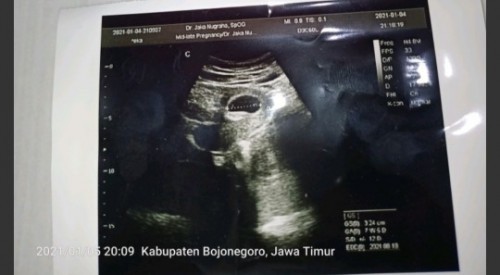 Usia kehamilan 7 mingu tapi janin saya blm terlihat ada yg mngalami seperti sya Bun pasrah sm Allah