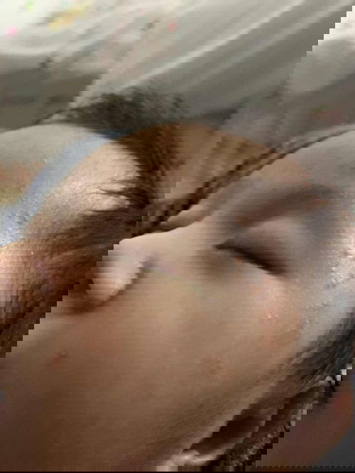 Mụn li ti ở trẻ sơ sinh
