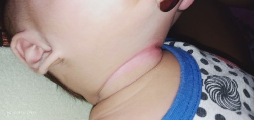 Mga mommies ano po dpat ilagay pag gnyan neck ng lo nYo po...