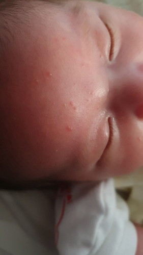 Baby acne or heat rash?