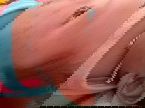 ผื่นขึ้นแบบนี้หายไม่ค่ะกี่วันน้องได้1เดือนเเร้ว