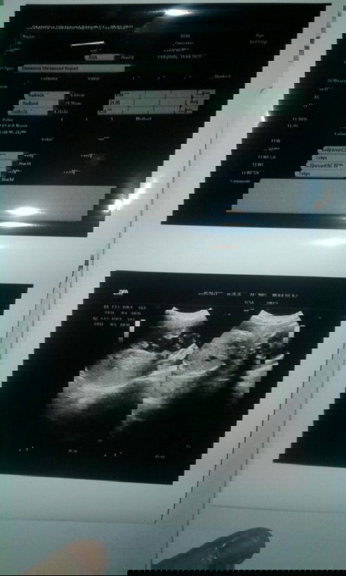 Hasil USG bacanya gmna